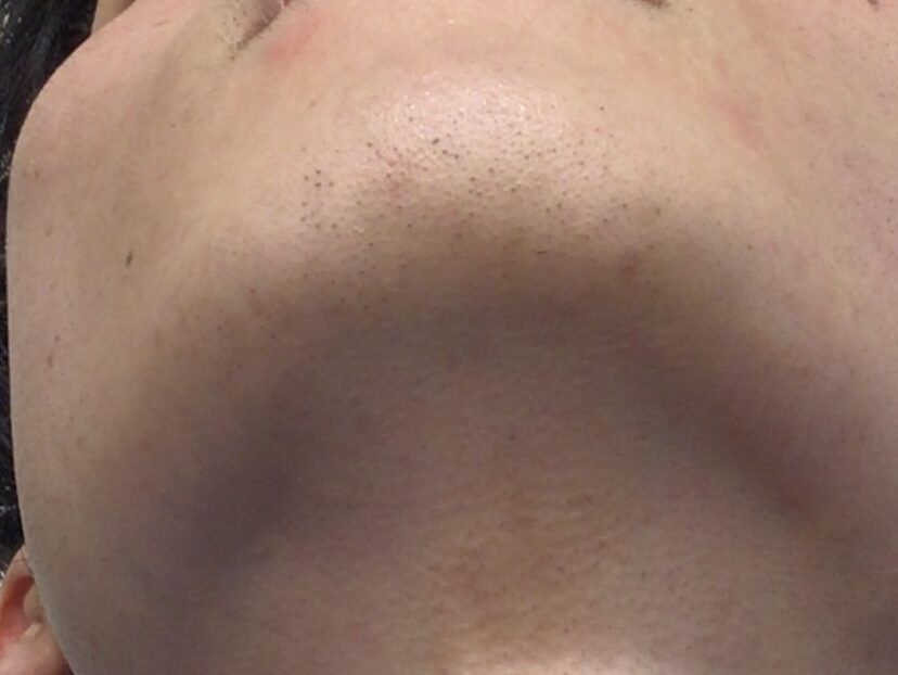 ヒゲ脱毛（顔脱毛）の症例After画像