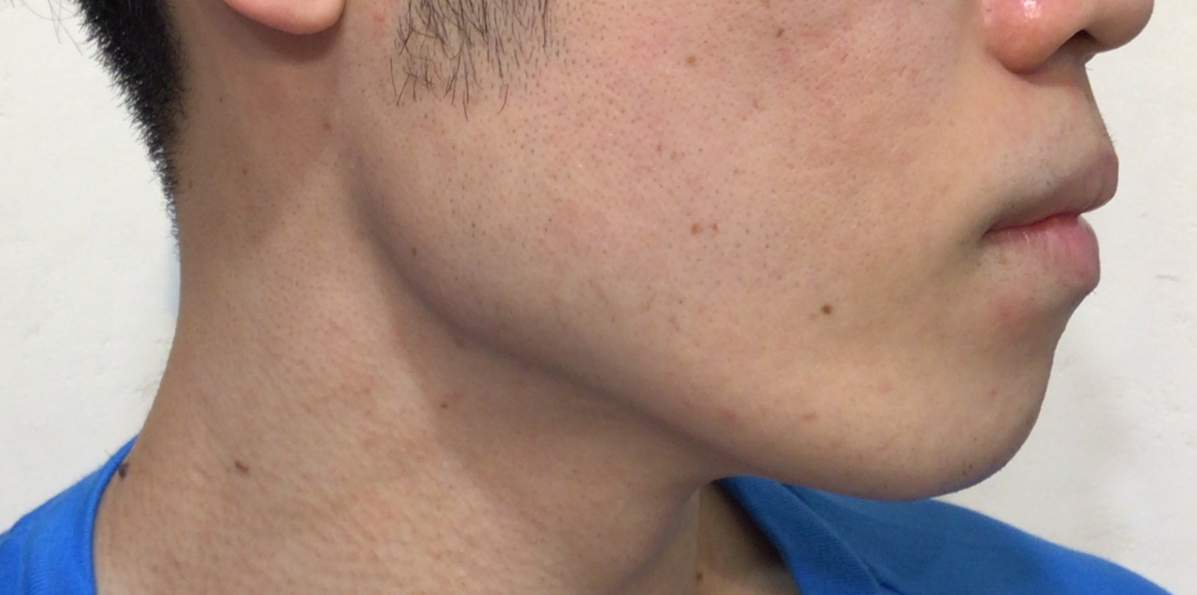 ヒゲ脱毛（顔脱毛）の症例After画像