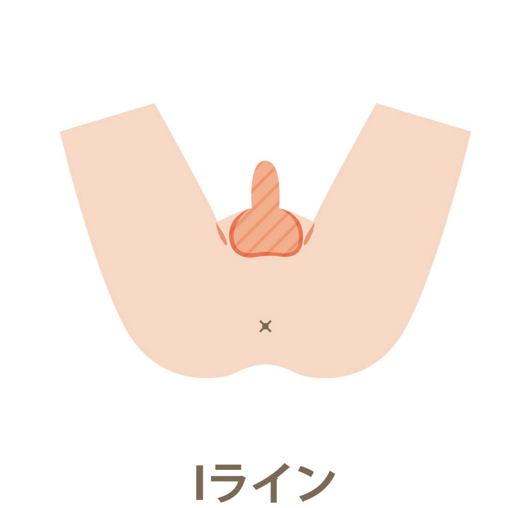 Iライン