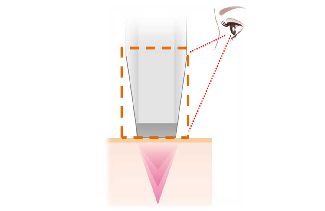 医療ハイフ（HIFU）テクノロジーとは？