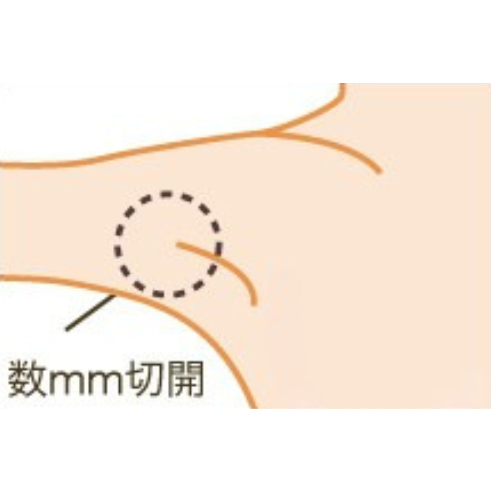 ワキガの治療（腋臭症吸引法）とは