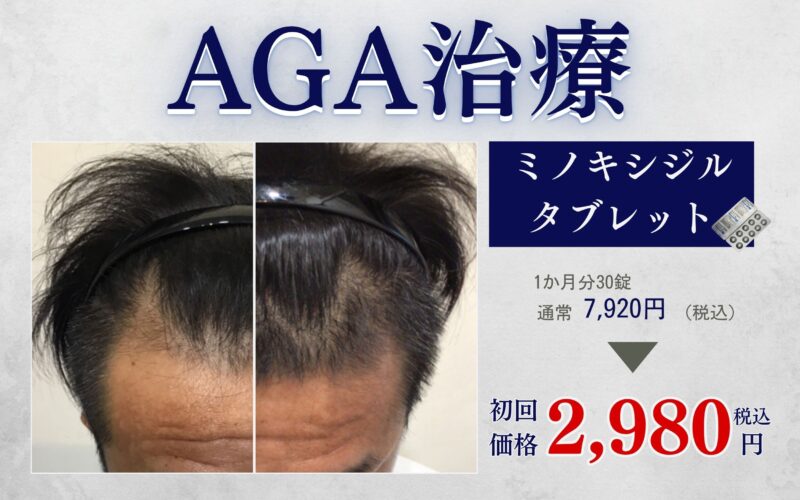 【初回特価】AGA治療ミノキシジルタブレット│太田院・高崎院の美容皮膚科・美容外科