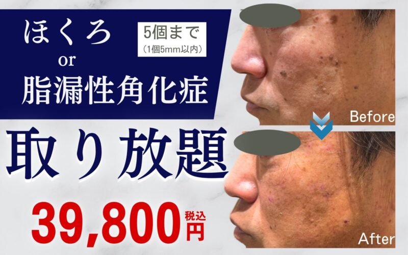 特別ご優待・ほくろor脂漏性角化症取り放題│太田院・高崎院│美容クリニック