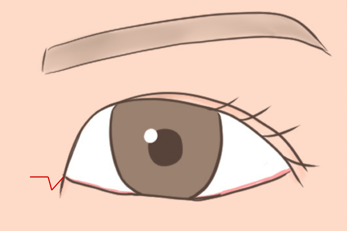 目頭切開